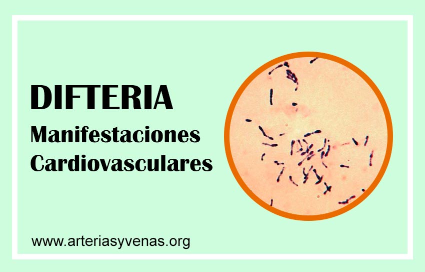 Difteria, manifestaciones cardiacas